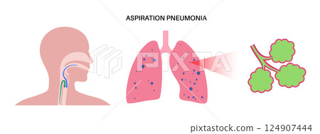 Aspiration pneumonia poster 124907444