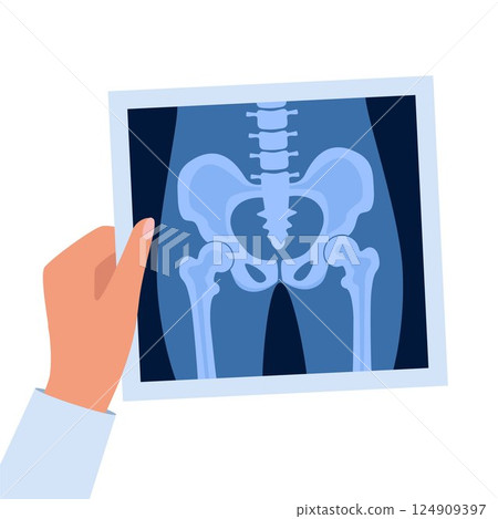 XRay of hip joint pelvis human bones anatomy orthopedic medical diagnostic. Roentgen shot in doctors hand. Vector illustration. 124909397