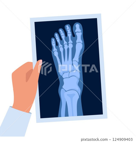 X ray human foot. X-ray picture or radiographic monitor image of metatarsus bones and toes. Medical radiology. Roentgen shot in doctors hand. Vector illustration. X ray human foot. X-ray picture or radiographic monitor image of metatarsus bones and toes. Medical radiology. Roentgen shot in doctors hand. Vector illustration. 124909403