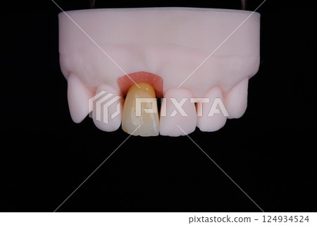 Mirror copy of central maxillary incisor, zirconia crown on titanium abutment fixed on printed model 124934524