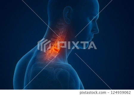 3D Medical Illustration Highlighting Neck Pain and Cervical Spine Injury 3D Medical Illustration Highlighting Neck Pain and Cervical Spine Injury 124939062