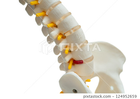 Spinal nerve and bone, Lumbar spine displaced herniated disc fragment, Model for treatment medical in the orthopedic department. 124952659