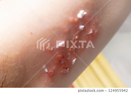 Woman with shingles on the skin she feels very painful Woman with shingles on the skin she feels very painful 124955942