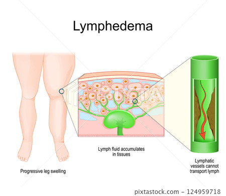 Lymphedema. Cross section of a skin with Lymph node 124959718