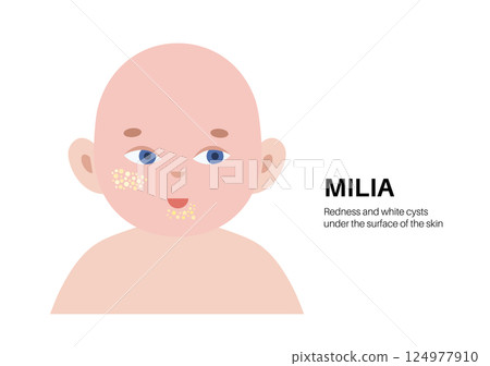 Milia face disease Milia face disease 124977910