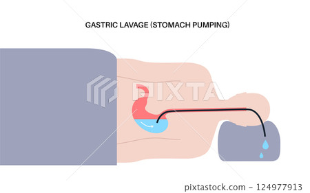 Stomach wash gastric lavage 124977913