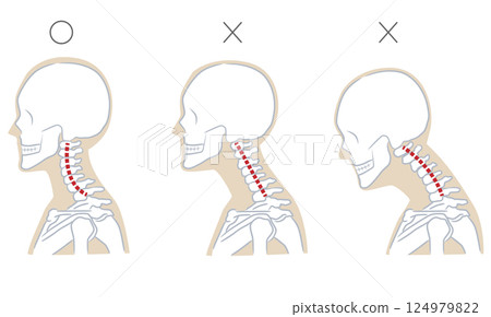 Normal cervical curve, straight neck, cervical kyphosis 124979822