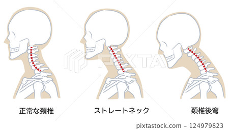 Normal cervical curve, straight neck, cervical kyphosis 124979823