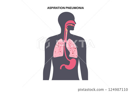 Aspiration pneumonia poster 124987110