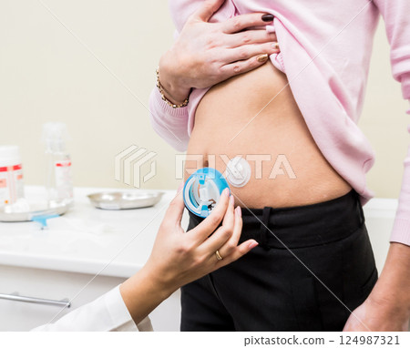 Doctor install patient insulin catheter for a simple injection of insulin. Doctor install patient insulin catheter for a simple injection of insulin. 124987321