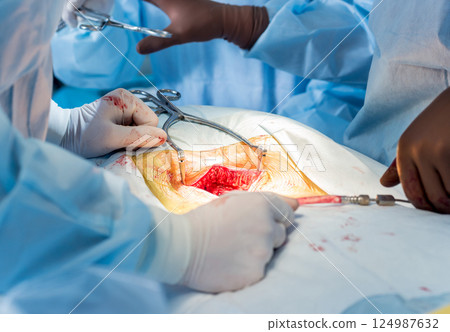 Spinal surgery. Group of surgeons in operating room with surgery equipment. Spinal surgery. Group of surgeons in operating room with surgery equipment. 124987632