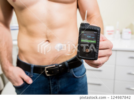 Diabetic man with an insulin pump connected in his abdomen and keeping the insulin pump Diabetic man with an insulin pump connected in his abdomen and keeping the insulin pump 124987842