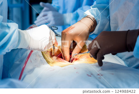 Spinal surgery. Group of surgeons in operating room with surgery equipment.  124988422