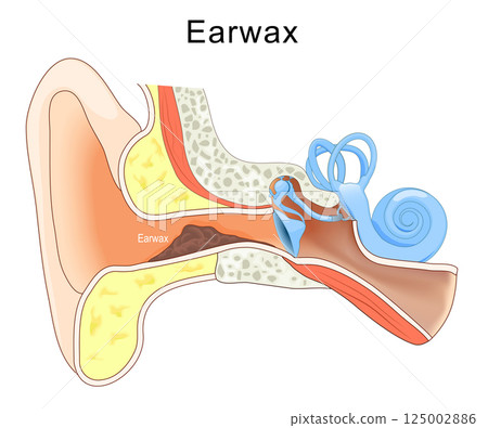 Earwax. ear with Cerumen in External auditory canal. 125002886