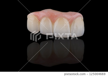 Naturally dental bridge with artificial gum made of zirconium for fixation to frontal upper teeth. 125004669
