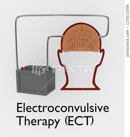 Electroconvulsive Therapy concept Electroconvulsive Therapy concept 125011956