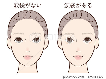 有和沒有淚袋的對比插圖 |參考如何改變眼睛的印象、整形手術和化妝 125014327