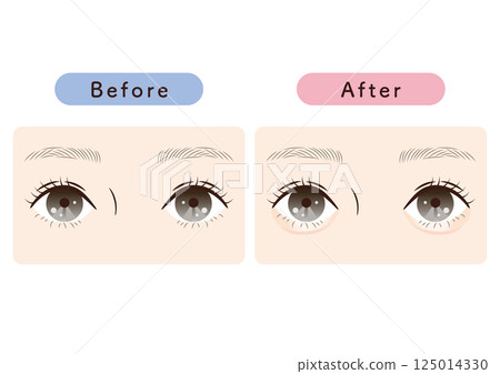 Comparison illustrations with and without tear bags | For reference on how to change the impression of your eyes, plastic surgery, and makeup Comparison illustrations with and without tear bags | For reference on how to change the impression of your eyes, plastic surgery, and makeup 125014330