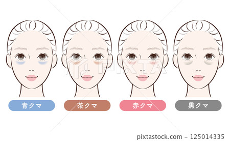 四種黑眼圈類型對比 |用於解釋美容和皮膚護理的插圖 125014335