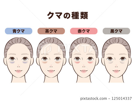 四種黑眼圈類型對比 |用於解釋美容和皮膚護理的插圖 125014337