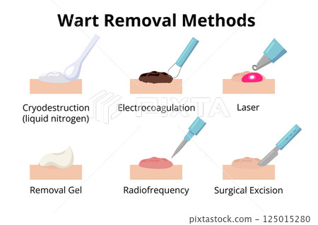Different wart removal methods illustrations 125015280
