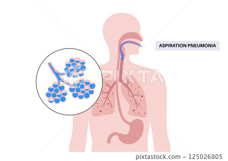 Aspiration pneumonia poster Aspiration pneumonia poster 125026805