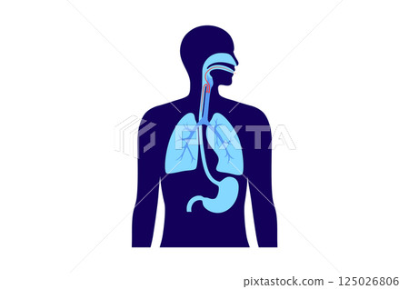 Aspiration pneumonia poster 125026806