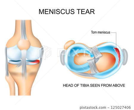 Meniscus tear 125027406