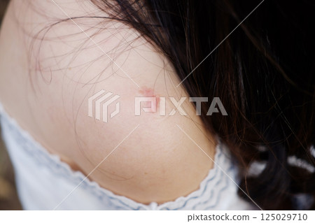 Close up BCG vaccination scars awaken an abscess on shoulder of Asian woman. Bacillus Calmette Gurin vaccine 125029710