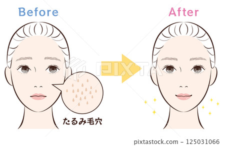 鼻毛孔問題：前後對比 |毛孔鬆弛 125031066