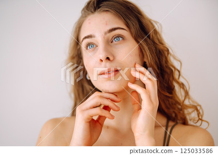 Portrait of a beautiful woman with inflammations on the skin of her face. Medicine and cosmetology. 125033586