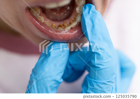 Dentist examining teeth with dental calculus and plaque where also fixed a retainer. Dentist examining teeth with dental calculus and plaque where also fixed a retainer. 125035790