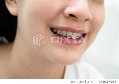 Asian woman wearing Hawley retainer removable orthodontic appliance maintain position of teeth. Asian woman wearing Hawley retainer removable orthodontic appliance maintain position of teeth. 125037995