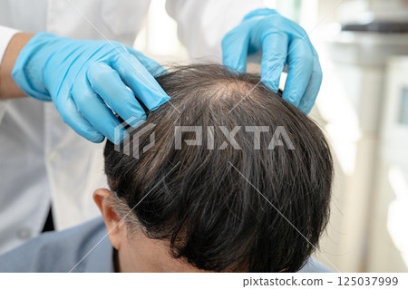 Doctor checkup and treatment Asian man baldness hair problem patient. 125037999