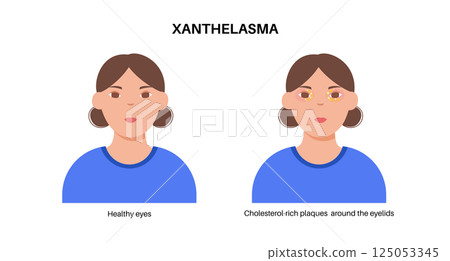 Xanthelasma skin disease Xanthelasma skin disease 125053345
