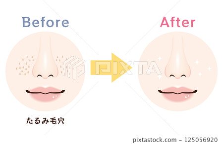 Nose pore problems: before and after | sagging pores 125056920