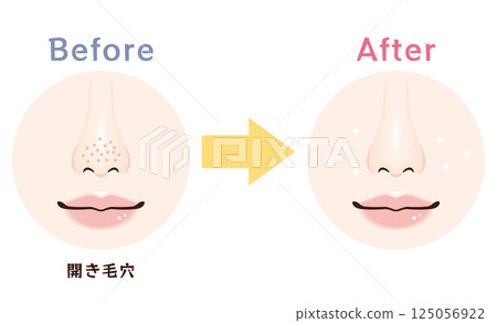 Nose pore problems: before and after | Open pores 125056922