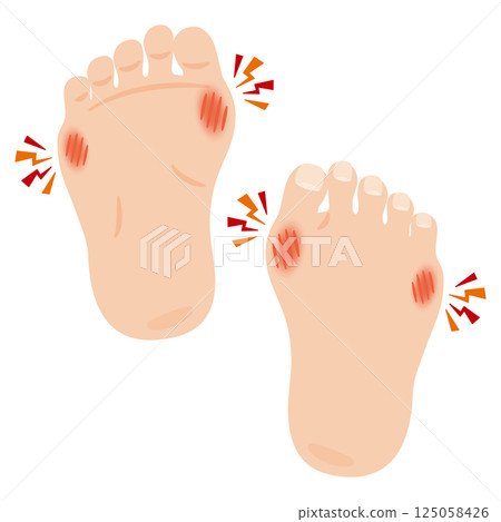 Illustration of hallux valgus Illustration of hallux valgus 125058426