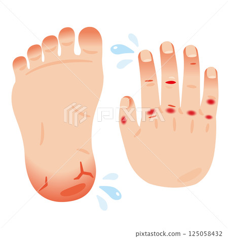 Illustration of the soles of the feet and the backs of the hands with inflammation such as chapped skin and cracks 125058432