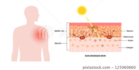 Skin damage from sunburn 125060660