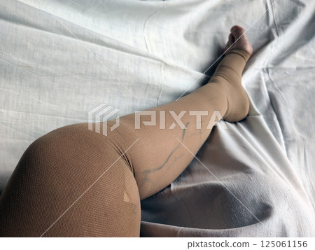 Treatment after varicose vein operation. Leg with a compression stocking after laser operation of saphenus vein. Treatment after varicose vein operation. Leg with a compression stocking after laser operation of saphenus vein. 125061156