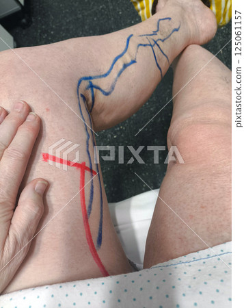 Unrecognizable patient prepared for varicose vein operation. Saphenus vein. 125061157