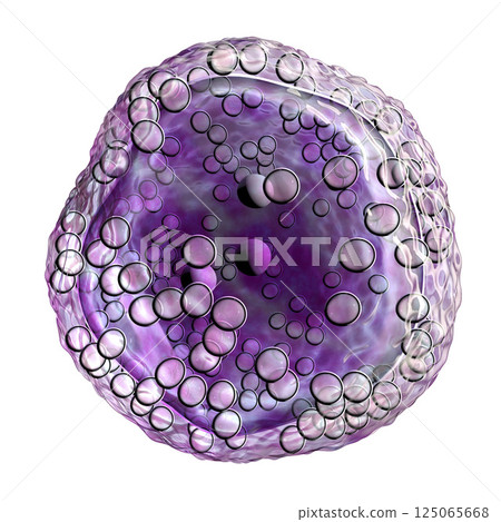 Burkitt's lymphoma cell, is a cancer of the lymphatic system 125065668