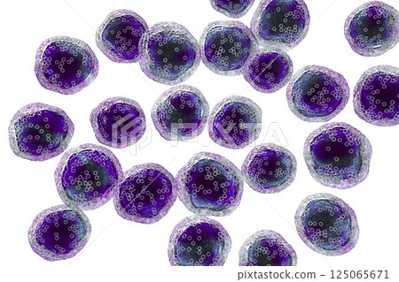 Burkitt's lymphoma cells, is a cancer of the lymphatic system Burkitt's lymphoma cells, is a cancer of the lymphatic system 125065671
