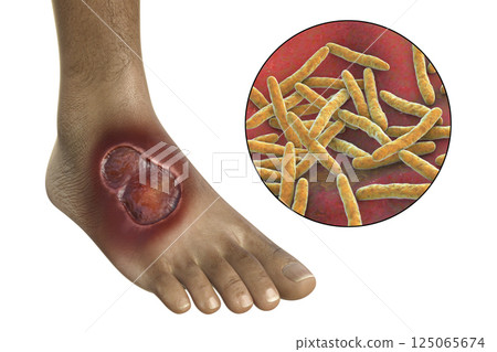 Buruli ulcer on a patient foot, 3D illustration. The disease caused by Mycobacterium ulcerans bacteria 125065674