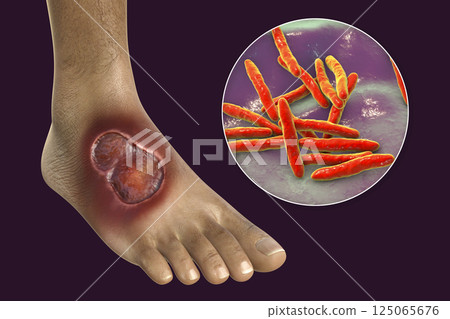 Buruli ulcer on a patient foot, 3D illustration. The disease caused by Mycobacterium ulcerans bacteria 125065676