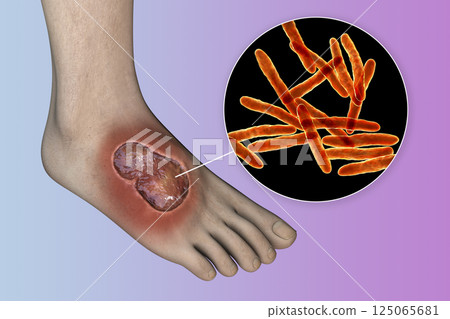Buruli ulcer on a patient foot, 3D illustration. The disease caused by Mycobacterium ulcerans bacteria 125065681