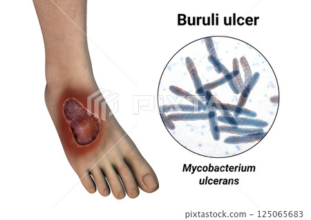 Buruli ulcer on a patient foot, 3D illustration. The disease caused by Mycobacterium ulcerans bacteria Buruli ulcer on a patient foot, 3D illustration. The disease caused by Mycobacterium ulcerans bacteria 125065683