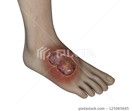 Buruli ulcer on a foot, 3D illustration. The disease caused by Mycobacterium ulcerans bacteria Buruli ulcer on a foot, 3D illustration. The disease caused by Mycobacterium ulcerans bacteria 125065685