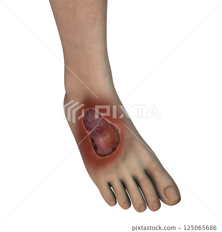 Buruli ulcer on a foot, 3D illustration. The disease caused by Mycobacterium ulcerans bacteria Buruli ulcer on a foot, 3D illustration. The disease caused by Mycobacterium ulcerans bacteria 125065686